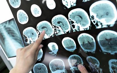 Detectan nuevas pistas para la identificación temprana de Alzheimer